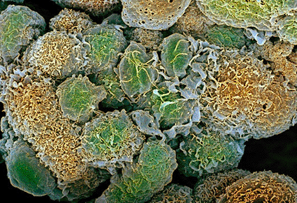 Image: Colored scanning electron micrograph (SEM) of breast cancer cells (Photo courtesy of Steve Gschmeissner / SPL).